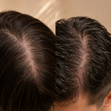 الحل الألماني لتهدئة وترطيب فروة الرأس الجافة والحساسة | German Calm & Hydrate Scalp Solution